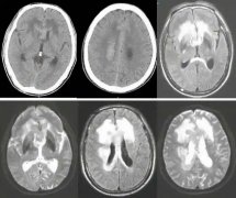 氢气通过调控线粒体动态平衡和功能改善脓毒症相关性脑病