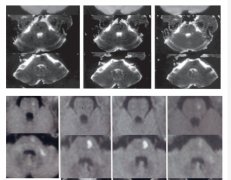 博天堂在线水减轻脑缺血再灌注损伤后神经细胞自噬性死亡的研究