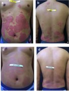 氢水泡。阂疾〖案币疾』颊叩母Ｒ