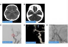 脑血管瘤合并系统红斑狼疮氢疗案例报道