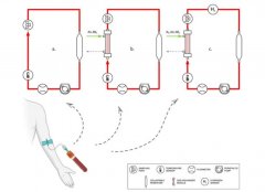 氢气用于改善ECMO抗炎症