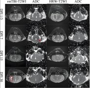 氢气和颅脑损伤研究综述