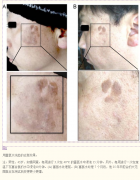 博天堂在线水浴对内脏脂肪和皮肤斑点的影响，具有耐沸腾的氢气泡