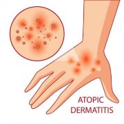 氢气对皮肤过敏和湿疹有没有效果？