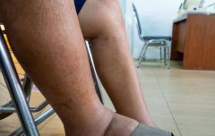 出现这些症状的时候，可能你的血糖超标！用氢或可逆转