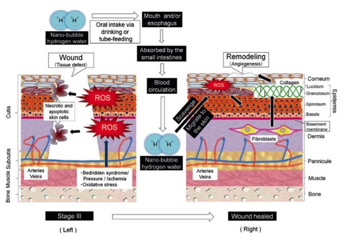 饮用氢水适用于褥疮临床试验