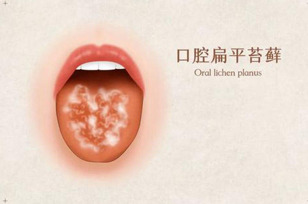 口腔扁平苔藓是怎么引起的 氢气水或可清洁口腔 清新口气