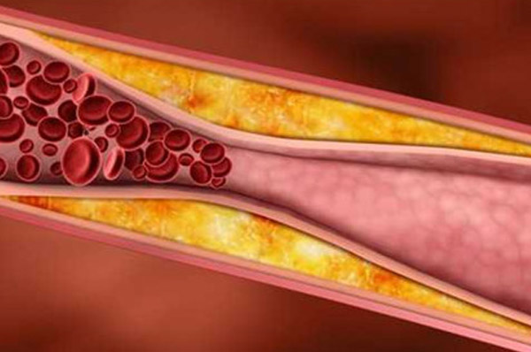 动脉粥样硬化是怎么回事 氢气：血管健康的“清道夫”