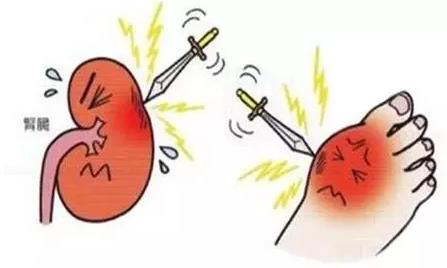 尿酸高？那你就离不开氢了！