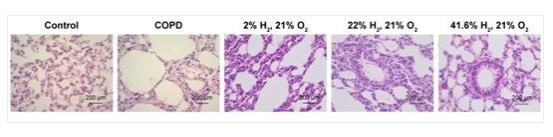 氢气改善癌症的故事：氢气“护”肺