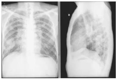 氢气改善癌症的故事：氢气“护”肺