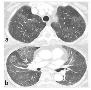 氢气改善癌症的故事：氢气“护”肺
