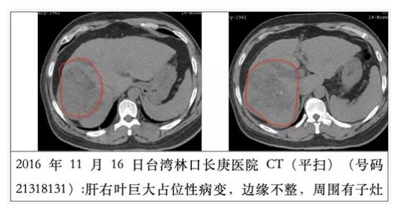 氢改善癌症：他患肝癌，改善很顺畅
