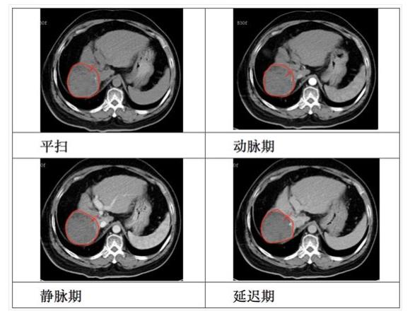 氢改善癌症：他患肝癌，改善很顺畅