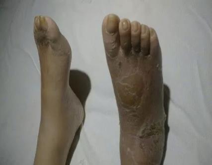 厉害了，我的氢！糖足都可以改善