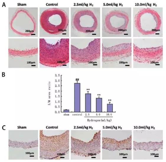 心脏血管内膜增厚可要命，氢气或能解决这个难题