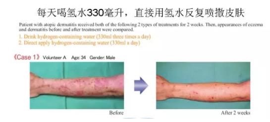 氢气改善疾病真那么牛吗？