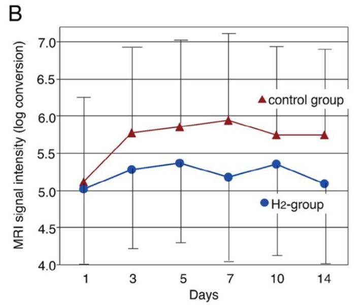 最新氢气改善中风关键临床研究结果