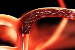 脑梗是威胁生命的杀手，吸氢或是您忠实的保镖！