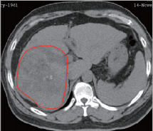 氢气控癌连载（3）||氢气与肝癌：出乎意料
