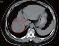 氢气控癌连载（3）||氢气与肝癌：出乎意料