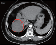 氢气控癌连载（3）||氢气与肝癌：出乎意料