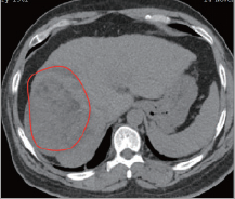 氢气控癌连载（3）||氢气与肝癌：出乎意料