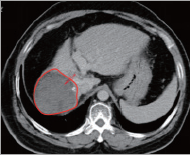 氢气控癌连载（3）||氢气与肝癌：出乎意料