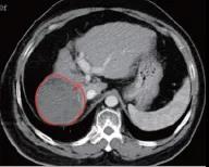 氢气控癌连载（3）||氢气与肝癌：出乎意料