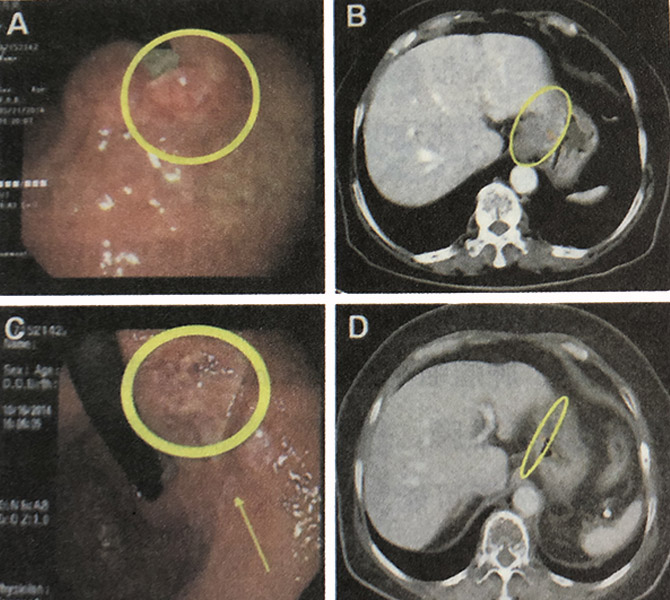 氢气可以辅助胃癌放化疗，与放化疗同时应用
