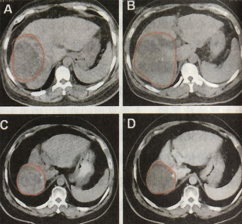 氢气可以辅助肝细胞癌放化疗，与放化疗同时应用