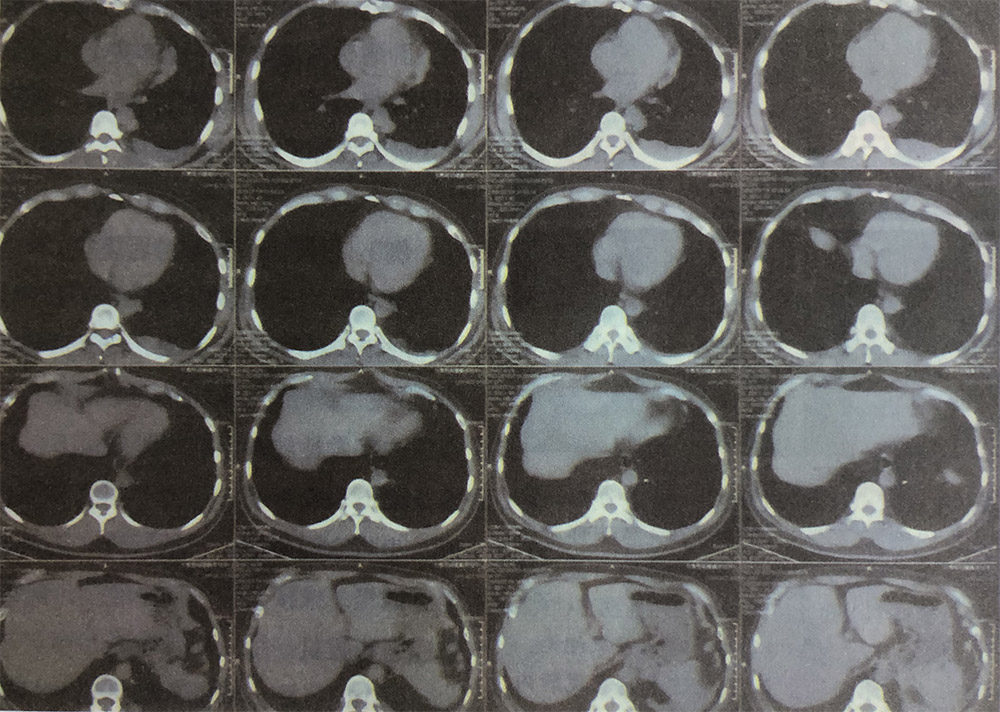 胸腺癌手术后的氢气辅助改善情况