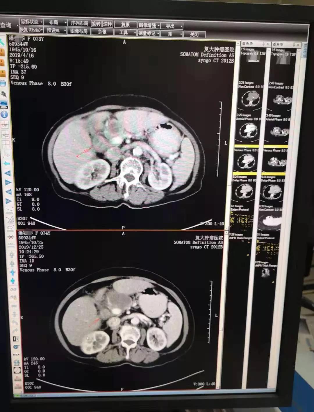 奇迹仍在延续，吸氢“起死回生”胆囊癌病人已胖20斤！