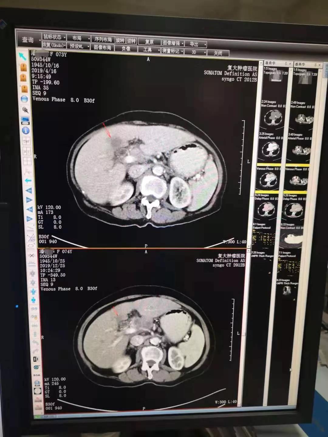 奇迹仍在延续，吸氢“起死回生”胆囊癌病人已胖20斤！