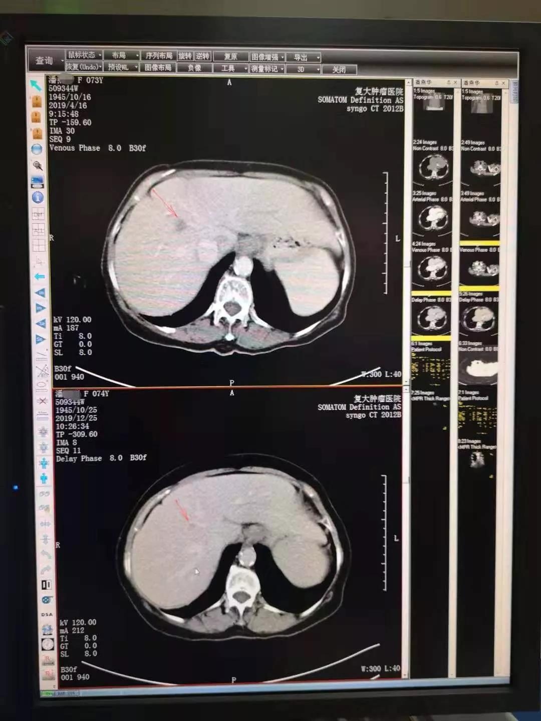 奇迹仍在延续，吸氢“起死回生”胆囊癌病人已胖20斤！