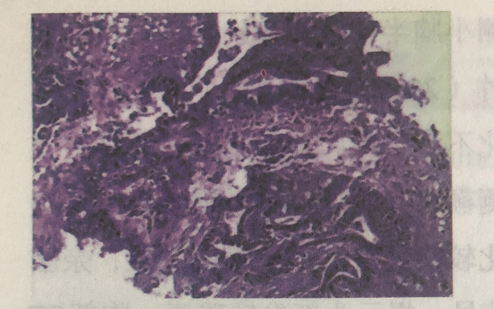 胆囊癌的氢气辅助改善作用，摘自氢气控癌