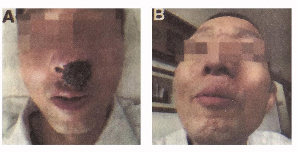 肝细胞癌肝移植后复发，每天吸氢3~4小时看效果