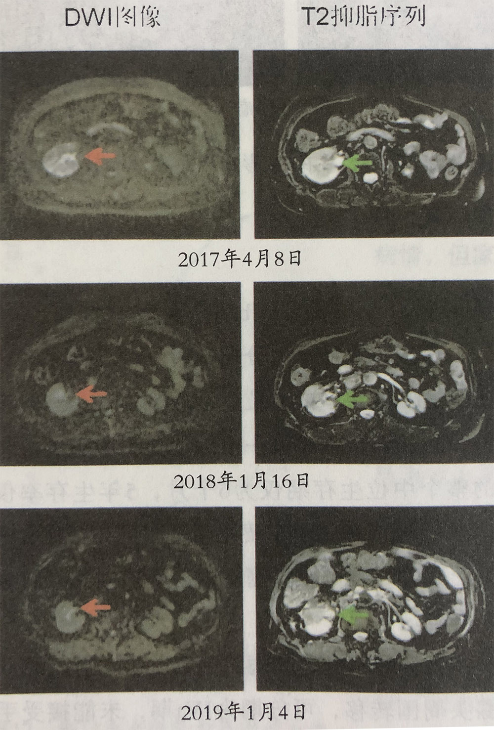 输尿管腺癌的氢气辅助作用，吸氢前后比较