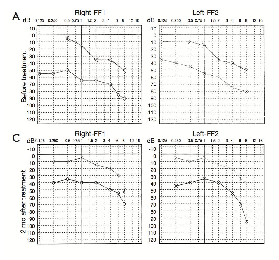 氢案例|重度高血压患者：吸氢4个月后，医生说不需要特殊改善了