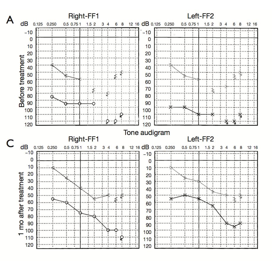 氢案例|重度高血压患者：吸氢4个月后，医生说不需要特殊改善了
