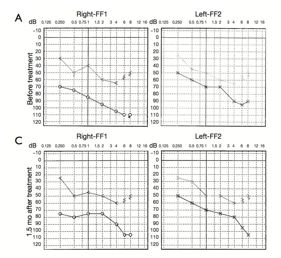 氢案例|重度高血压患者：吸氢4个月后，医生说不需要特殊改善了