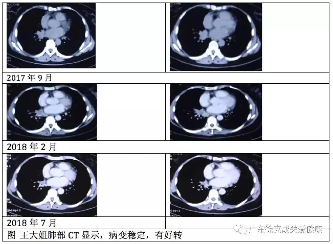临床报告显示｜吸氢后，肺癌脑转移完全消失了。