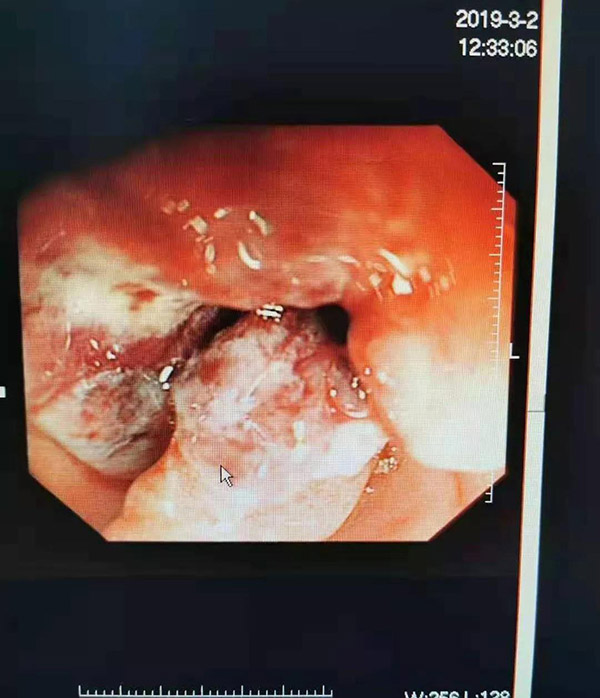 她的肿瘤神奇消失，谁的功劳？