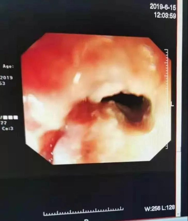 她的肿瘤神奇消失，谁的功劳？