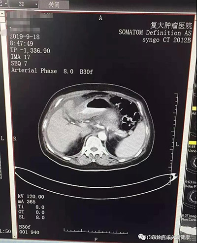 她的肿瘤神奇消失，谁的功劳？