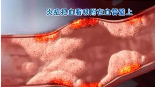 中风危险知多少？