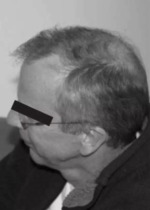 德国：氢气对慢性疲劳综合征的神奇效果