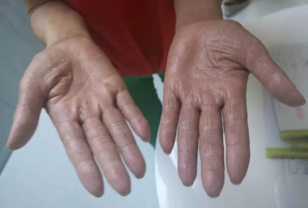 睡眠好、病痛少……他们吸氢的意外收获真不少！