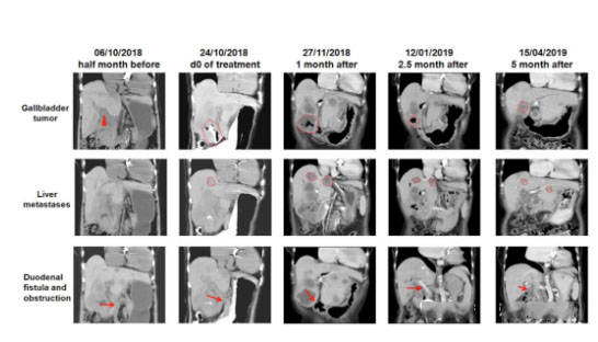 晚期胆管癌吸氢案例，在国际学术期刊发表！