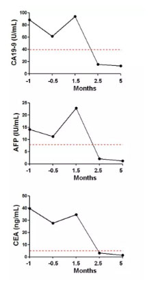 晚期胆管癌吸氢案例，在国际学术期刊发表！